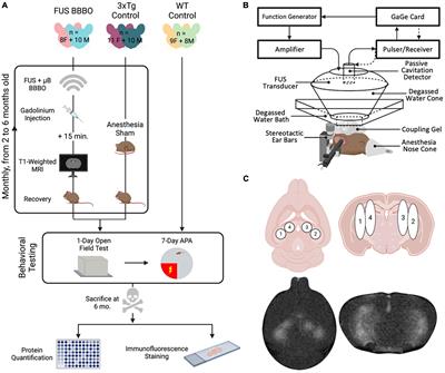 Getting ahead of Alzheimer’s disease: early intervention with focused ultrasound